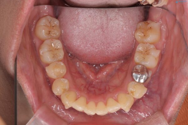 気になる犬歯のガタつきをマウスピース矯正で改善 治療中画像
