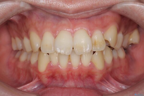 気になる犬歯のガタつきをマウスピース矯正で改善 ビフォー