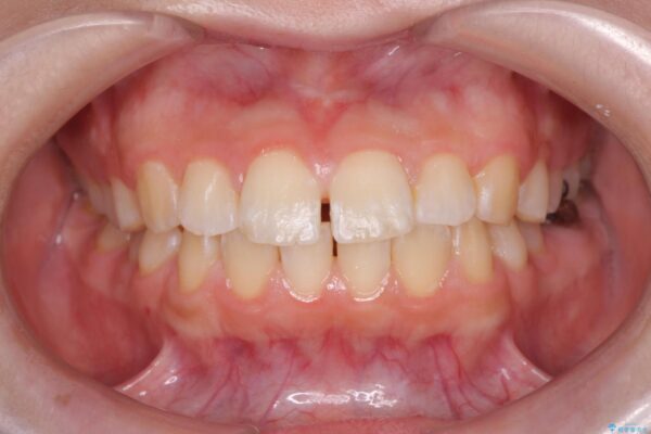 前歯の隙間と口元の突出感を改善したい 治療前画像