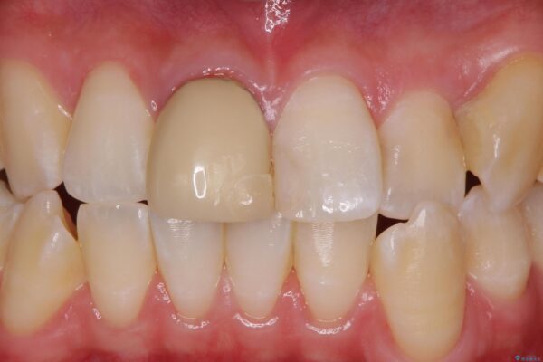 保険のかぶせ物の色が気になる ビフォー