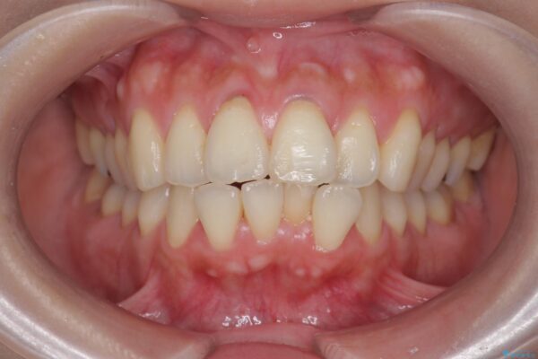 上下前歯のガタつきをインビザラインで改善 ビフォー
