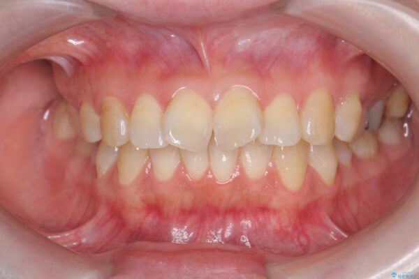 傾いた前歯、インビザラインで改善 ビフォー