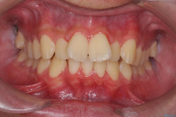 気になる出っ歯、インビザラインで改善 ビフォー