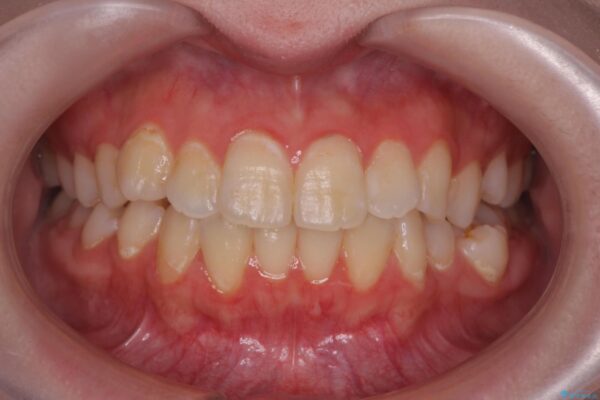 奥歯のガタつきをマウスピース矯正で改善 ビフォー