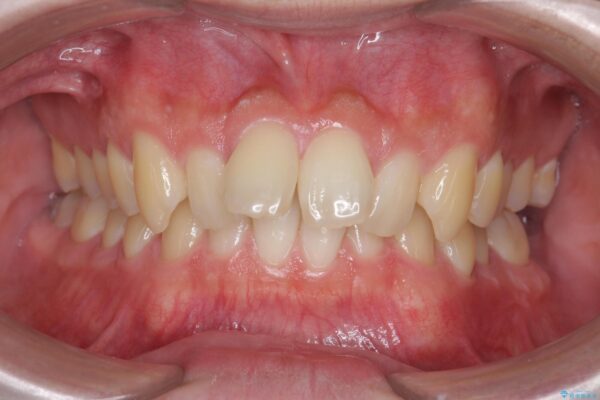 前歯のガタつきをマウスピース矯正で改善 治療前画像