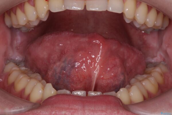 舌小帯を切除し滑舌を治したい ビフォー