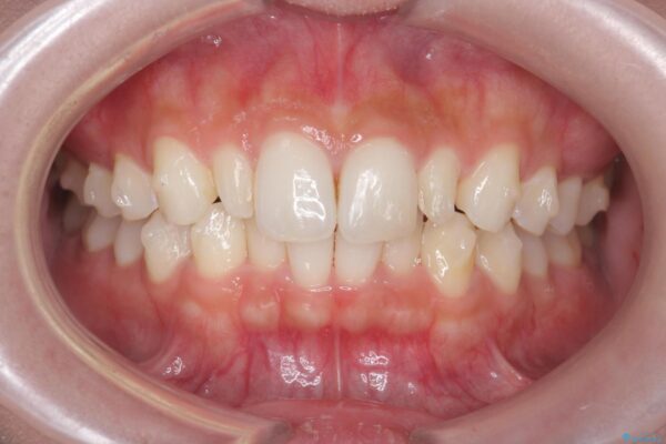 前歯のガタつきと矮小歯をインビザラインとセラミック治療で改善 治療前画像