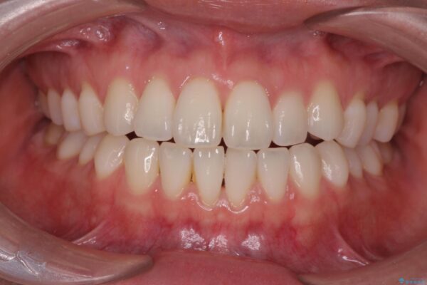 かみ合わない前歯、マウスピースで短期間矯正 治療前画像