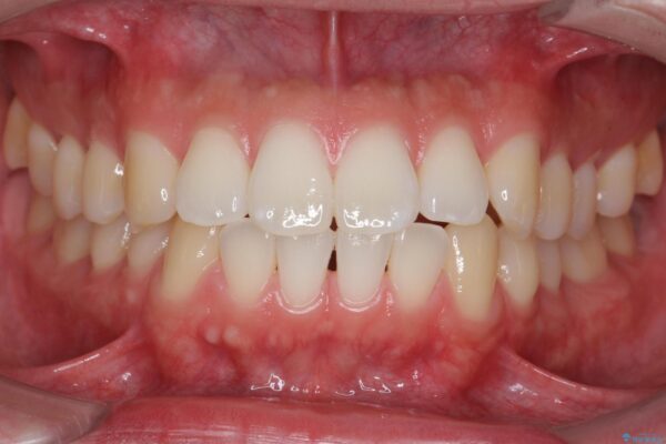 前歯のガタつきを短期間矯正 治療前画像