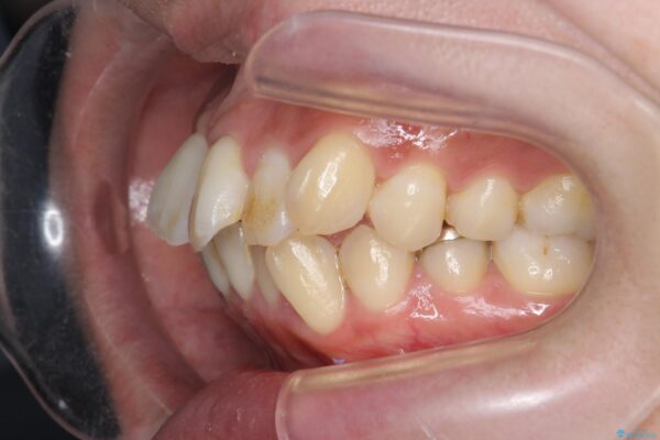 気になる犬歯のガタつきをマウスピース矯正で改善 治療前画像