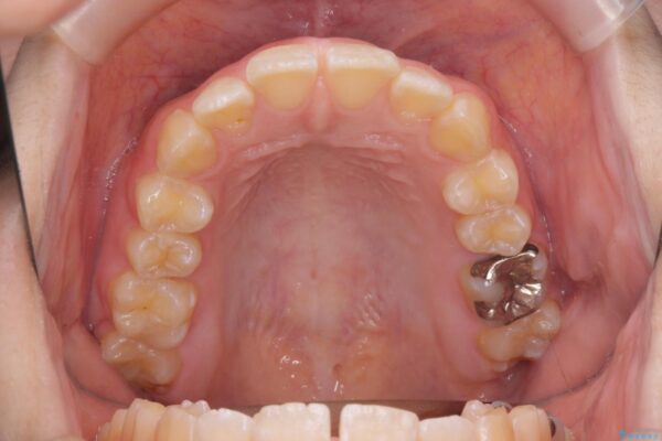 前歯の隙間と口元の突出感を改善したい 治療前画像