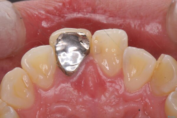 保険のかぶせ物の色が気になる 治療前画像