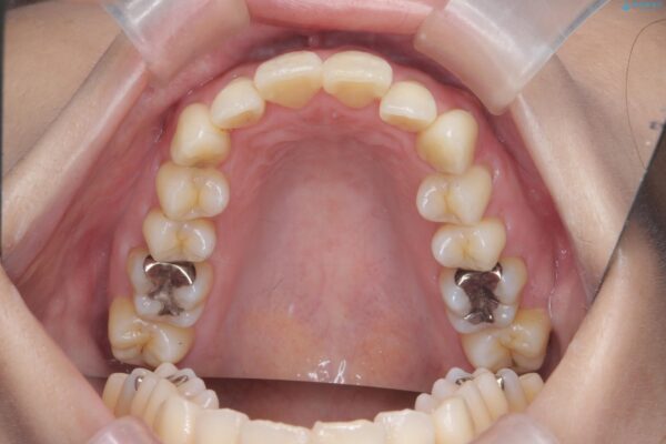 上下前歯のガタつきをインビザラインで改善 治療前画像