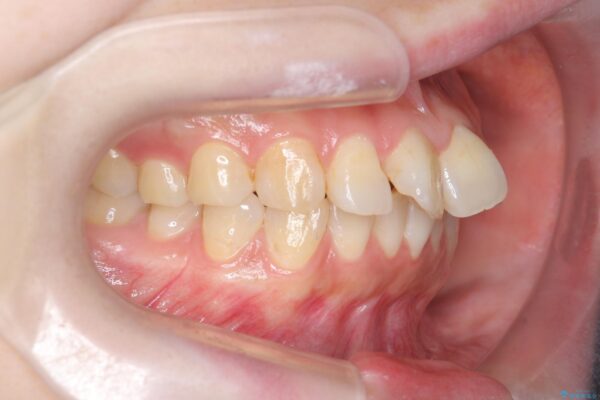 傾いた前歯、インビザラインで改善 治療前画像