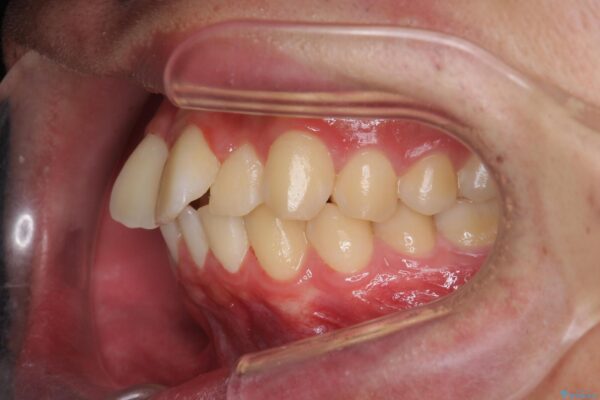 気になる出っ歯、インビザラインで改善 治療前画像