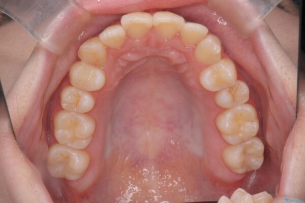 奥歯のガタつきをマウスピース矯正で改善 治療前画像