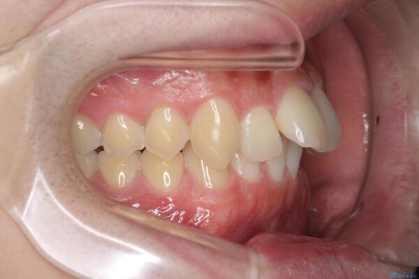 前歯のガタつきをマウスピース矯正で改善 治療前画像