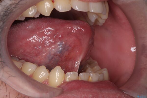 舌小帯を切除し滑舌を治したい 治療前画像