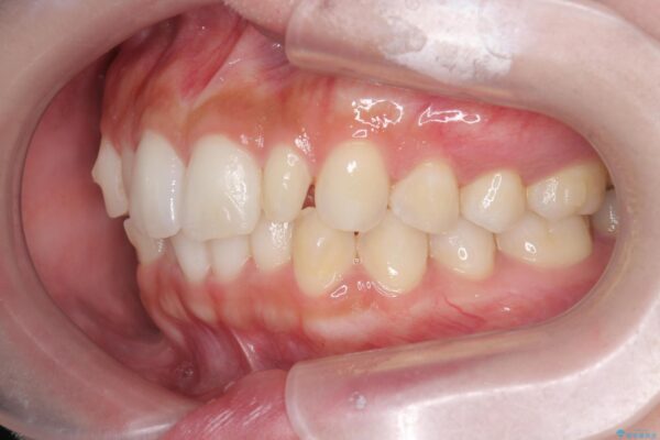 前歯のガタつきと矮小歯をインビザラインとセラミック治療で改善 治療前画像