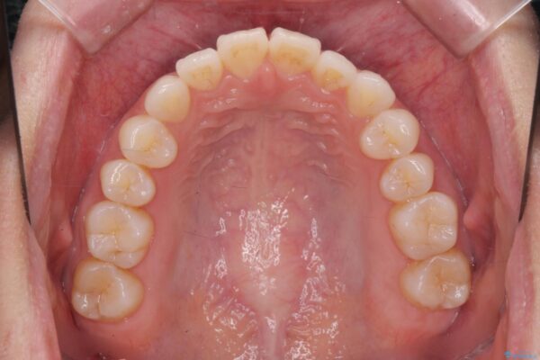 かみ合わない前歯、マウスピースで短期間矯正 治療前画像