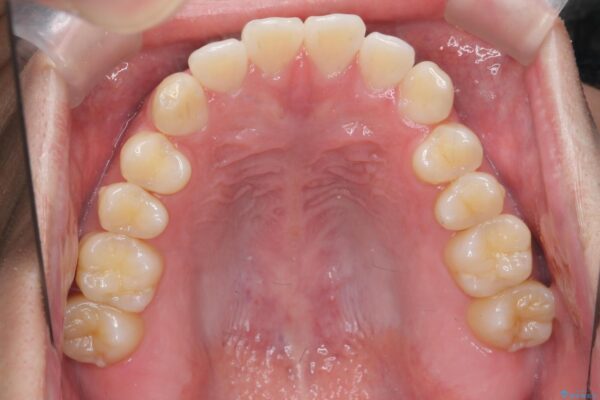 前歯のガタつきを短期間矯正 治療前画像