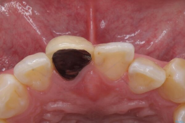 保険のかぶせ物の色が気になる 治療前画像