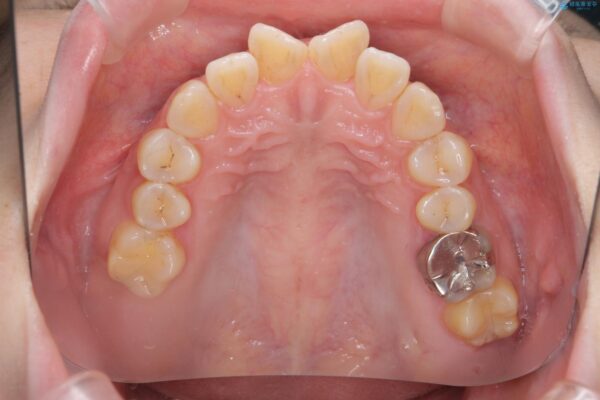 傾いた前歯、インビザラインで改善 治療前画像