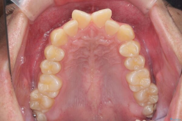 気になる出っ歯、インビザラインで改善 治療前画像