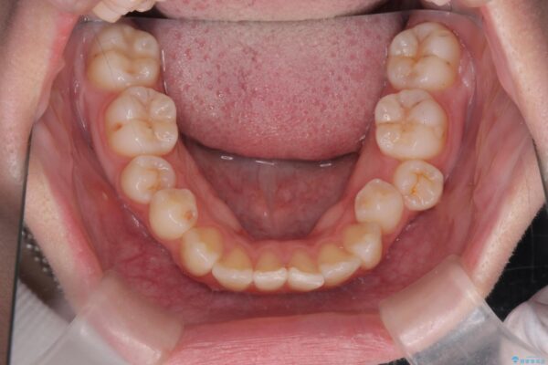 奥歯のガタつきをマウスピース矯正で改善 治療前画像