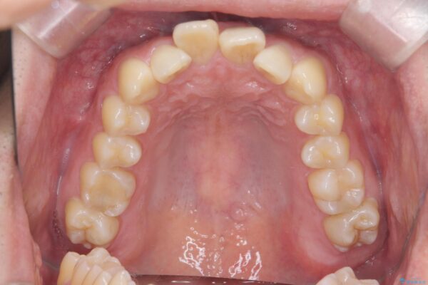 前歯のガタつきをマウスピース矯正で改善 治療前画像