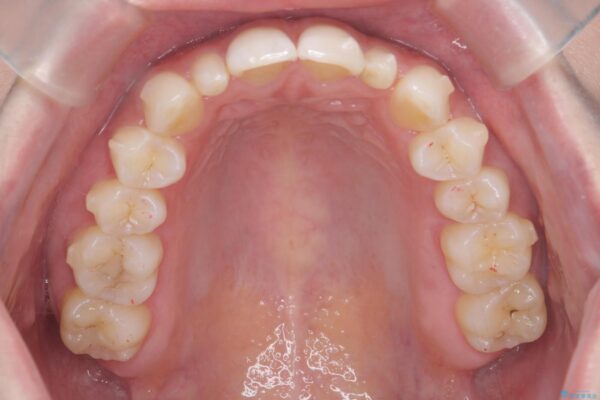 前歯のガタつきと矮小歯をインビザラインとセラミック治療で改善 治療前画像