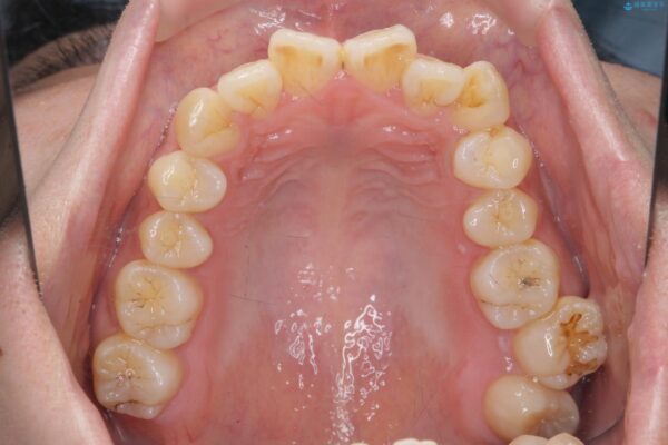 気になる犬歯のガタつきをマウスピース矯正で改善 治療前画像