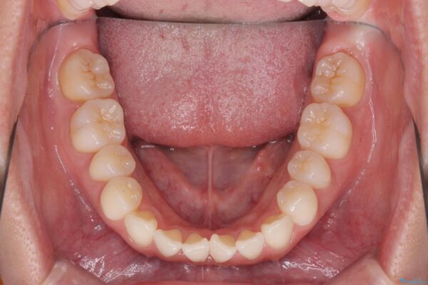 かみ合わない前歯、マウスピースで短期間矯正 治療前画像