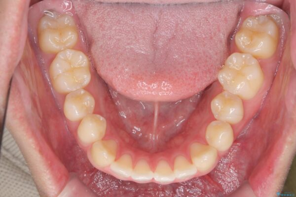 前歯のガタつきを短期間矯正 治療前画像