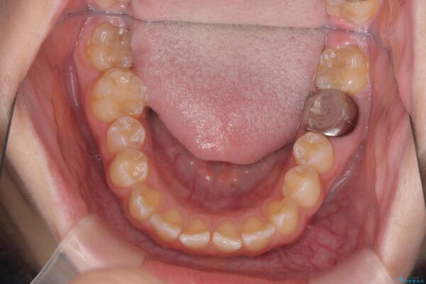 前歯の隙間と口元の突出感を改善したい 治療前画像