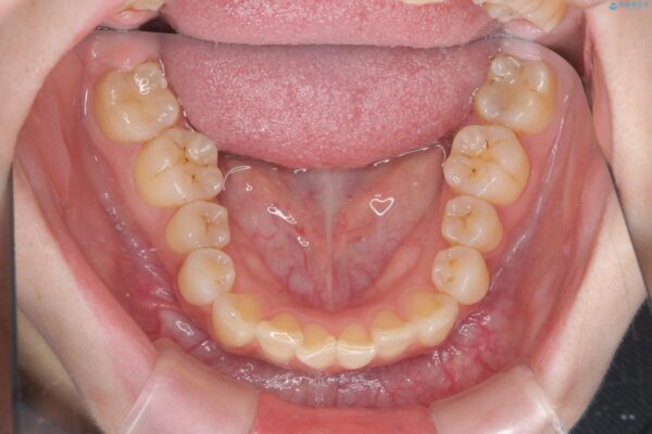 傾いた前歯、インビザラインで改善 治療前画像