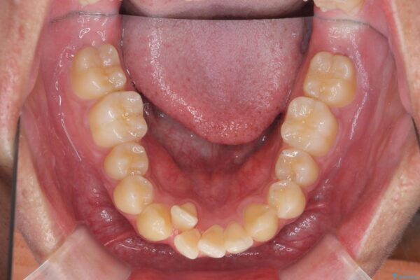 気になる出っ歯、インビザラインで改善 治療前画像