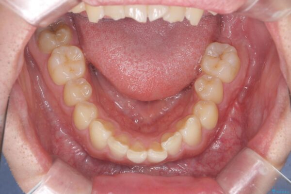 前歯のガタつきをマウスピース矯正で改善 治療前画像