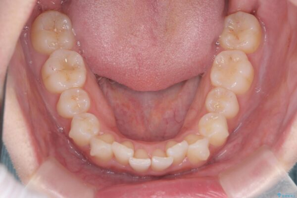 前歯のガタつきと矮小歯をインビザラインとセラミック治療で改善 治療前画像