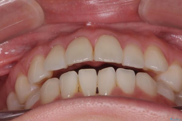 かみ合わない前歯、マウスピースで短期間矯正 治療前画像