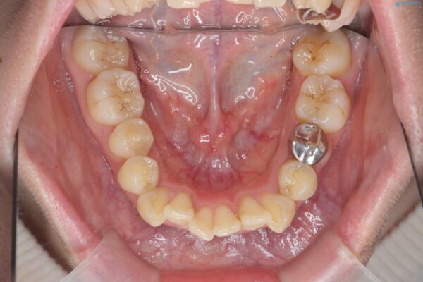 気になる犬歯のガタつきをマウスピース矯正で改善 治療前画像