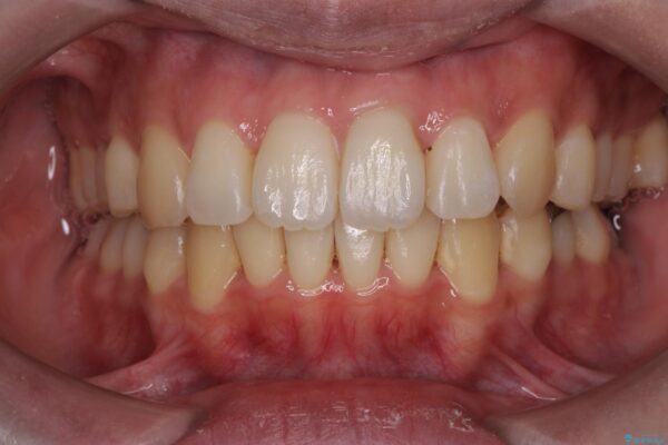 気になる犬歯のガタつきをマウスピース矯正で改善 アフター