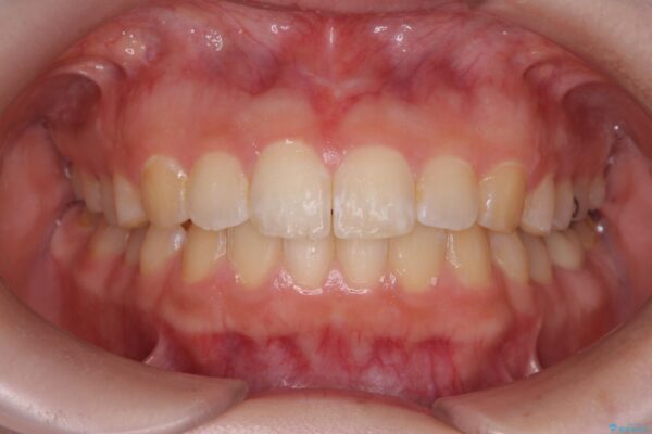 前歯の隙間と口元の突出感を改善したい 治療後画像