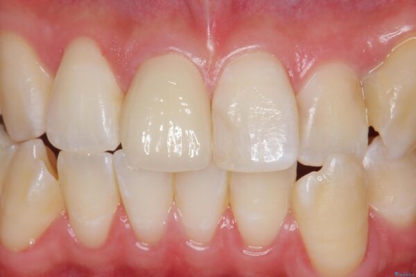 保険のかぶせ物の色が気になる アフター