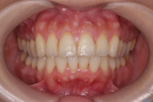 上下前歯のガタつきをインビザラインで改善 アフター