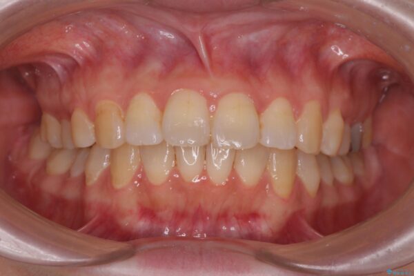 傾いた前歯、インビザラインで改善 アフター