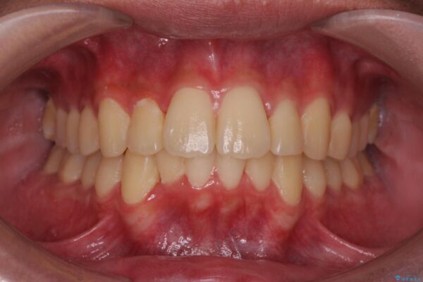 気になる出っ歯、インビザラインで改善 アフター