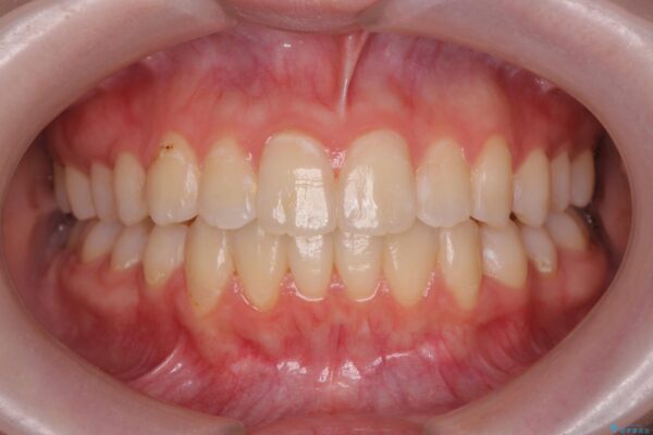 奥歯のガタつきをマウスピース矯正で改善 アフター