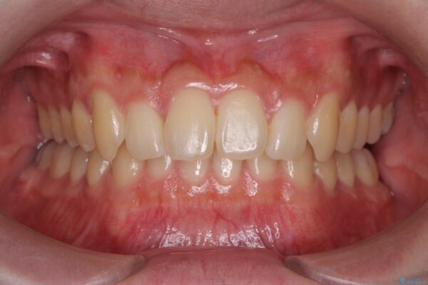 前歯のガタつきをマウスピース矯正で改善 治療後画像