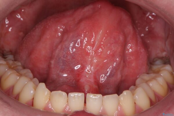 舌小帯を切除し滑舌を治したい アフター